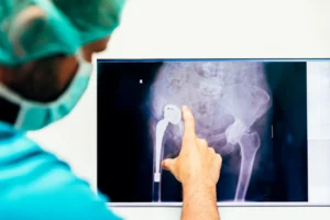 Hip Replacement